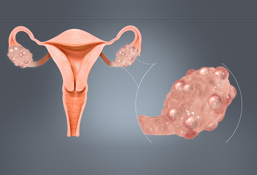 holistic treatment for pcos